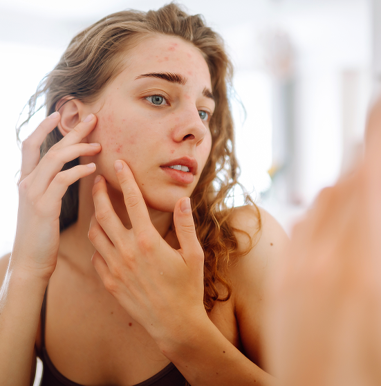Acne treatment Riyadh