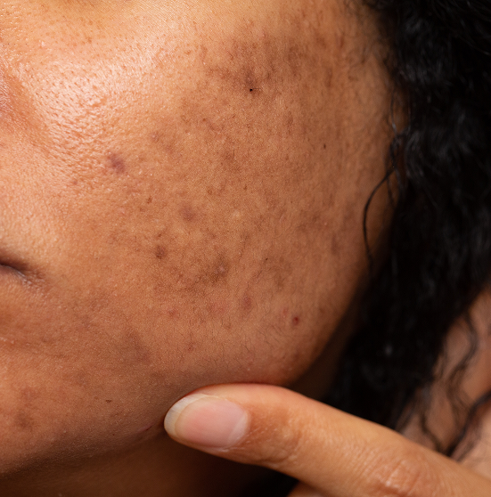 Acne Scar Treatment in Riyadh