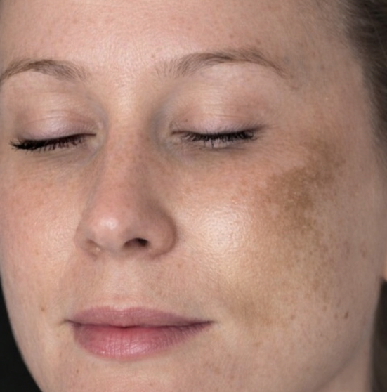 Pigmentation and melasma treatment