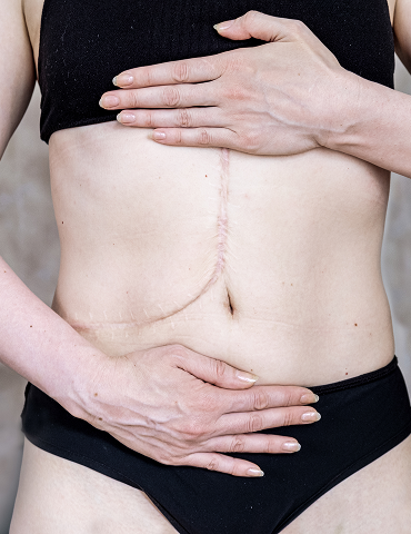 scar management