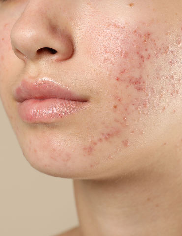 Acne Treatment