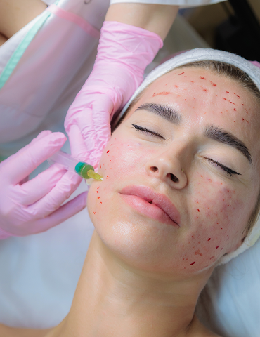 Acne Scar Treatment