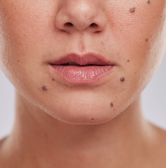 Mole & Skin Lesion Removal In Riyadh