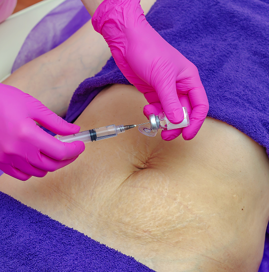 Stretch Mark Treatment