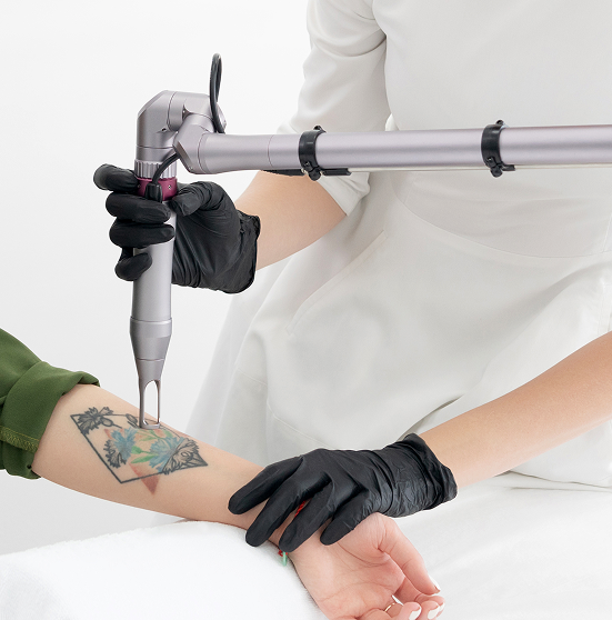 Deep Laser Resurfacing for Severe Scars