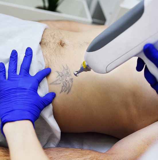Advanced Pigment & Tattoo Removal