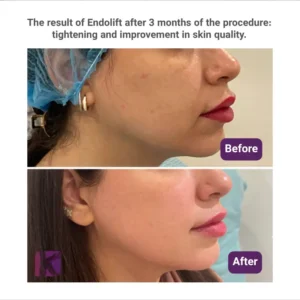 Close-up side profile of a patient showing Endolift before and after results, highlighting improved skin quality and a tightened jawline after 3 months