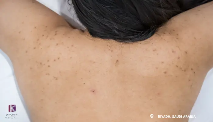acne scar on back