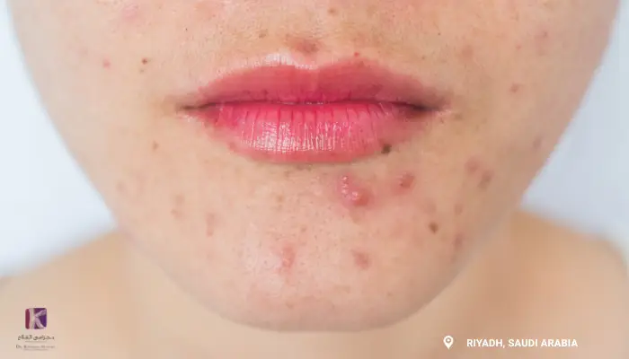 acne scar on face